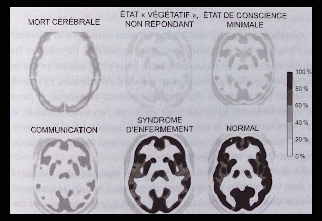 Clichés du PET-scan de la consommation énergétique du cerveau. © "Un si brillant cerveau", par Steven Laureys, Ed. Odile Jacob