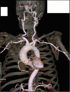 Visualisation des cavités cardiaques, du réseau coronaire et du réseau artériel au départ de la crosse de l’aorte. (Cliquer pour agrandir)