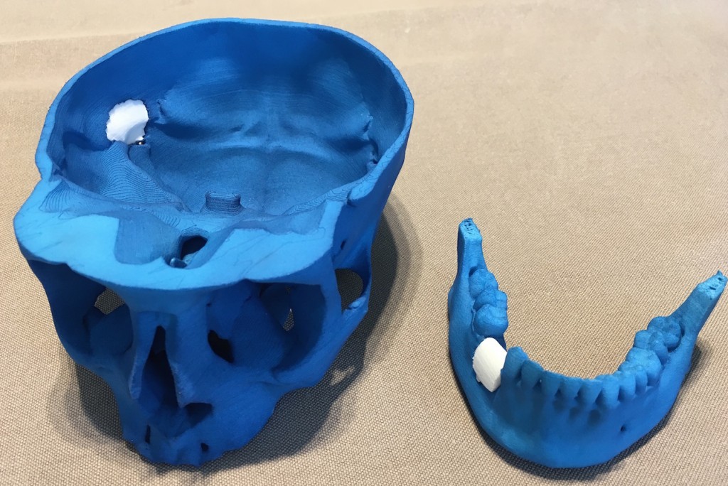 Implants en céramique imprimés en 3D, pour réparer les os du crâne et de la mâchoire.