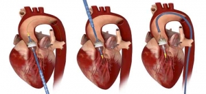 Le placement d'une nouvelle valve aortique par la technique TAVI peut se réaliser par voie apicale (1), transaortique (2), ou transfémorale (3).