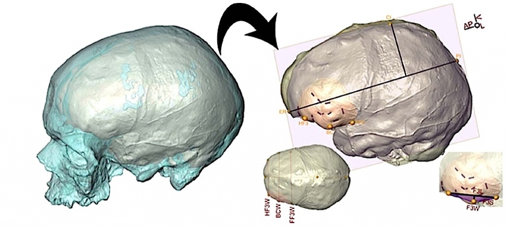 Le CT-scan permet de mieux cerner la morphologie du cerveau en analysant les structures de l'endocrâne