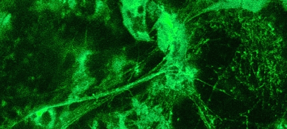Cellule en train d’expulser son propre ADN sous forme de filaments appelés “NETs” (« Neutrophil extracellular trap »)